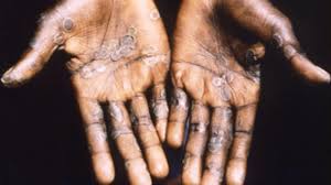 The first monkeypox patient caught the virus abroad before passing it to someone in their household in north wales. Two Cases Of Monkeypox Virus Found In Wales Uk News Sky News