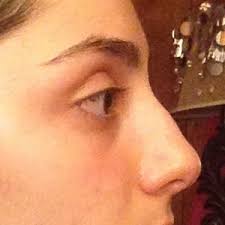 Anthem blue cross and blue shield is the trade name of anthem insurance companies, inc., independent licensee of the blue cross and blue shield association. How Much Of The Price Would Anthem Blue Cross Cover For Reconstructive Rhinoplasty I Am A 15 Y O Female Photos