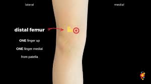 Subject of this article:ez io placement landmarks (page 1). Intraosseous Access