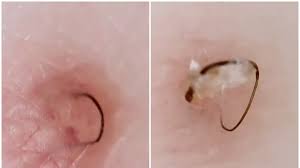 You may see pus in the spots. Ingrown Hair Removal Account Teen Vogue