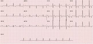 Um enfarte do miocárdio é uma emergência médica que requer tratamento imediato. Ecg Now