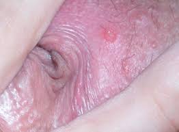 Should i put neoporin in it or will it heal on it's own. I Have Something Like A Blister Photos On The Inside Part Of The Right Labia Sexual Health Forums Patient
