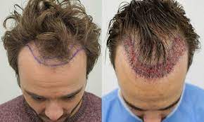 Brett bolton is the founder of great hair transplants, a hair restoration clinic specializing in hair implants for both men and women. Hair Loss Reasons Signs Hair Transplant Gomediran