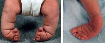 In some cases, the calf muscle and affected foot may be slightly smaller than normal. Clubfoot Orthoinfo Aaos