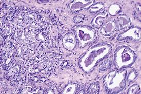 Benign Prostatic Hyperplasia Bph And Prostate Cancer What S The Difference Dana Farber Cancer Institute