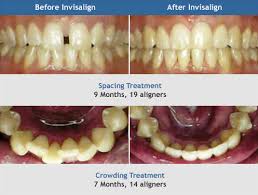 However, insurance may pay up to $1500 for invisalign costs. Invisalign Richmond Hill Vaughan Toronto Yonge 7 Dental