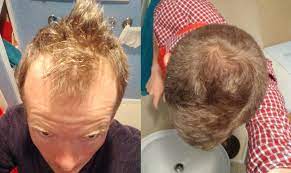So anything that increases bloodflow to the follicle should theoretically have a positive impact on hair growth. How I Thickened My Hair And Advanced My Hairline With A Simple Massage Technique And No Drugs J D Moyer