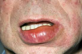 Angioedema Immune Disorders Merck Manuals Consumer Version