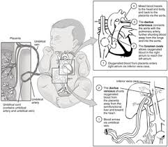 Image result for Delayed Transition from Fetal Circulation