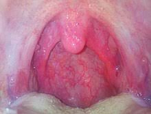 Eine bakterielle tonsillitis kann sich als komplikation einer viralen mandelentzündung entwickeln. Pharyngitis Wikipedia