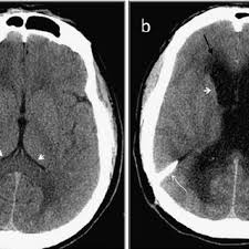 Pdf Detection Of Ventricular Shunt Malfunction In The Ed Relative Utility Of Radiography Ct And Nuclear Imaging