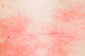 It turned out to be a really good risk. Case Report Sarcoidosis Mistaken For Cancer Progression