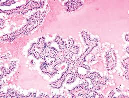 May 07, 2020 · cancer immunotherapies have changed the landscape of cancer treatment during the past few decades. The Thyroid Gland Chapter 42 Silverberg S Principles And Practice Of Surgical Pathology And Cytopathology