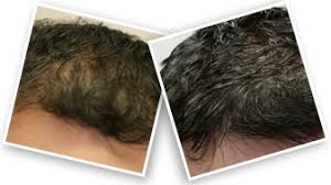 hair regrowth treatment minoxidil spray