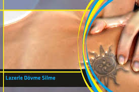 Lazerle Dovme Silme Dovme Uygulamalar