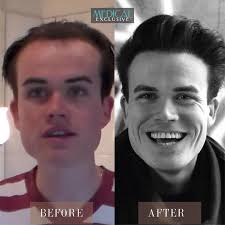 Wiese sehen macht Freude“ der YouTube Kanal von Daniel Wiese mit einer  hervorragenden Schilderung seiner Erfahrungen in einem Format von  Video-Diary. Deutschland hat durch Daniel Wiese alles über  Haartransplantationen erfahren @wiesionaer ...