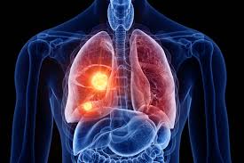 Cancer that arises from the jaw bone is termed primary jaw cancer. Mouth Microbiota Make Up Linked To Lung Cancer In Non Smokers