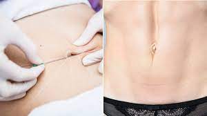 Here S Why Belly Button Plastic Surgery Is Trending Right Now Plastic Surgery Plastic Surgery Procedures Belly Button Piercing