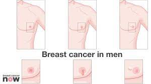 Symptoms include a painless mass, skin changes, or bloody or milky discharge from the nipple. Breast Cancer Now On Twitter Learn More About The Signs Symptoms Of Breastcancer In Men Look Out For Unusual Changes Malebreastcancer Https T Co Pfosomg13w Https T Co Hnpqlah6cr