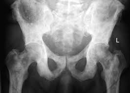 Prostate cancer (pca), a prominent metastatic dormant cancer, has the worst prognosis when found in the liver compared to other metastatic sites. Metastatic Cancer Bones Metastatic Cancer Of The Bone Female Urethral Carcinoma Metastatic Cancer Bones