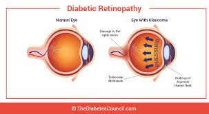 Type 1 diabetes symptoms can develop in just a few weeks or months and can be severe. Glaucoma And Diabetes Can Diabetes Affect Your Eyes