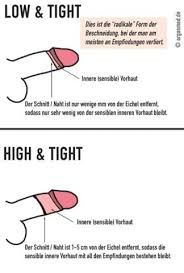 Man kann da manches noch klären, was schriftlich nicht geht. Beschneidung Usa Gesundheit Und Medizin Penis Vorhaut