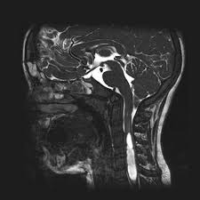 Image result for Syringomyelia