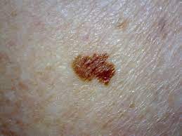 Having a stage 3 melanoma means a greater chance that the cancer will come back later somewhere else in the body (stage 4melanoma ). What Each Melanoma Stage Means