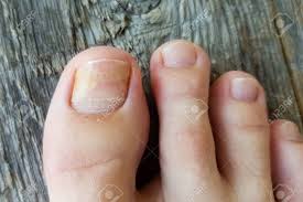 Image result for Onycholysis feet