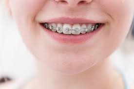 Check spelling or type a new query. 6 Ways To Get Your Braces Off Faster Thomas Orthodontics