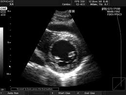Medison Ru Parasternal Short Axis View Cardiac Sonography Echocardiogram Ultrasound