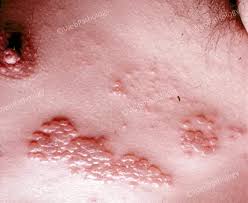 Image result for herpes zoster