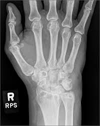 Image result for Wrist XRay
