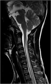 Image result for Myelitis