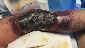 Simply put, wounds cannot heal when necrotic tissue is present. Extensive Purpura And Necrosis Of The Leg Mdedge Dermatology