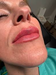 Scar revision and lip blushing services available