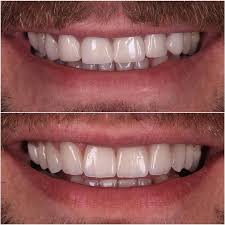 Zirconia Vs Ips E Max Oldukca Donuk Goruntuye Sahip Zirkonya Restorasyonlarin E Max Kuron Protezleri Ile Degistirilmesi Em Dentist Art Dentistry Dentist