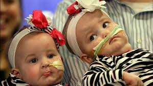 Once-conjoined N.Y. twins make debut at hospital
