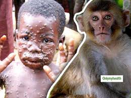 Most cases have been in africa. Monkeypox Virus Signs Symptoms Prevention Dr Thind S Homeopathy