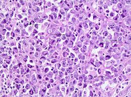 Vincent's hospital, melbourne, vic, australia; Pathology Outlines Anaplastic Large Cell Lymphoma Alk Positive