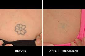 Though it is one of the cost: Laser Tattoo Removal In Malaysia Price Side Effects Aftercare And More