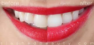 Review With Before After Crest 3d White Whitestrips Slashed Beauty