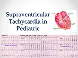 It's not usually serious, but some people may need treatment. Svt In Pediatrics