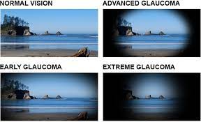 If neglected or uncontrolled, glaucoma first causes peripheral vision loss and eventually can lead to loss of sight. What Is Glaucoma Testing And Treatment Lee S Summit Eye Doctor