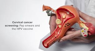 Image result for Cervical Cancer Screening