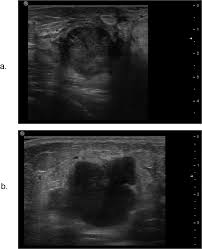 Breast cancer lumps do not usually hurt but a small percentage of people will experience painful breast cancer lumps. The Relationship Between Lateral Acoustic Shadow Feature On Ultrasound Download Scientific Diagram