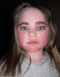 Coconut face mask left 10-year-old's skin red raw for FOUR days