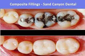 Composite Fillings In Irvine Ca Composite Fillings Dental Dental Restoration