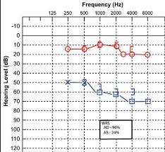 Pitch, or frequency, is measured in hertz and marked from left to right. Im Looking For An Audiogram For A Unilateral Hearing Loss Would You Be Able To Help