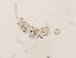 Image result for Urinary Cast